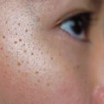 Hyperpigmentation and Dark Spots